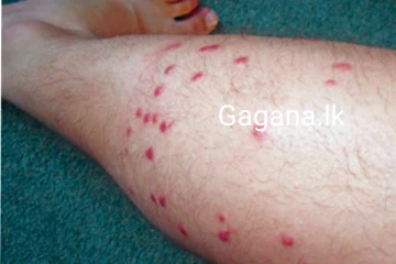 තවත් භයානක රෝගයක් ප්‍රදේශ කිහිපයක පැතිරයයි..ප්‍රවේශම් වන්න...