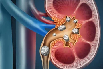 சிறுநீரக கற்களால் அவஸ்தைப்படுறீங்களா? அதனை குறைக்க இதோ சில வீட்டு வைத்தியம்!