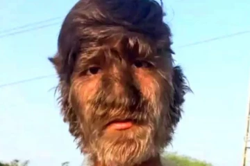 முகம் முழுவதும் முடி! விசித்திரமான நோயால் பாதிக்கப்பட்ட சிறுவன்