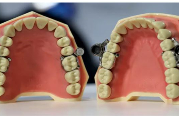 ஜிம்முக்கு போகாமல் உடல் எடையைக் குறைக்க வேண்டுமா? வந்து விட்டது  வாய்க்கு பூட்டுபோடும் புதிய கருவி! | Lose Weight New Tool Locks The Mouth