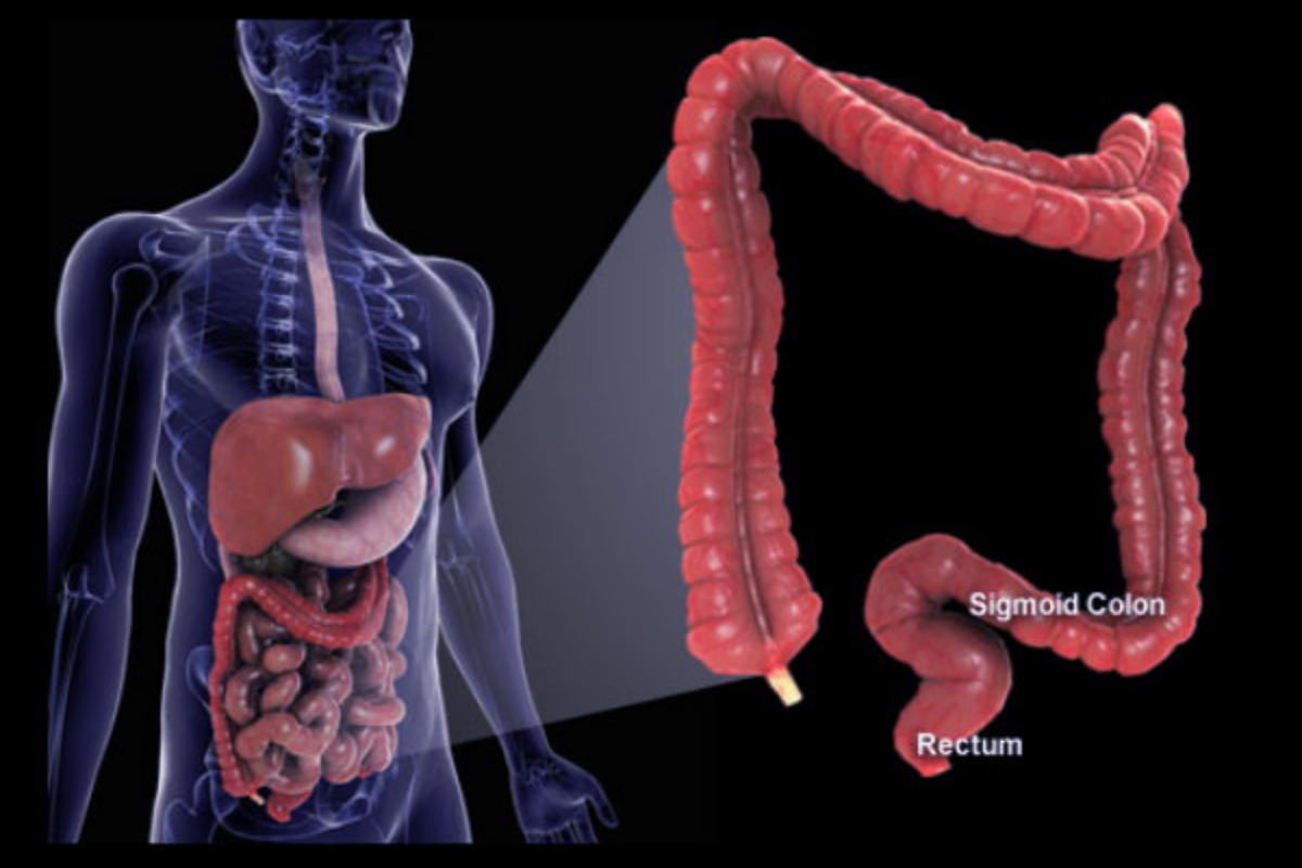 பெருங்குடல் புற்றுநோயின் அறிகுறிகள் என்னென்ன? | What Are The Symptoms Of Colon Cancer