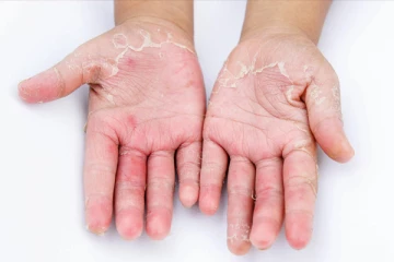 உங்கள் உள்ளங்கை தோல் உரியுதா? இதனை எப்படி போக்கலாம் தெரியுமா?