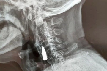 77 ஆண்டுகளுக்கு முன் சுடப்பட்ட நபர்: எக்ஸ்ரேயில் தெரிந்த அதிரவைத்த காட்சி