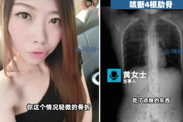 காரமாக சாப்பிட்டு விலா எலும்புகளை உடைத்துக்கொண்ட பெண்! சீனாவில் அதிர்ச்சி சம்பவம்