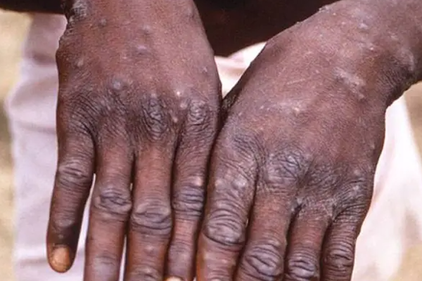 தீவிரமாக பரவும் குரங்கு அம்மை நோய் - உலக நாடுகள் அச்சம்..! - தமிழ்நாடு