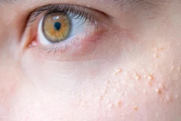 அடிக்கடி முகத்தில் பால் பருக்கள் வருதா? இதனை போக்க என்ன செய்யலாம்?