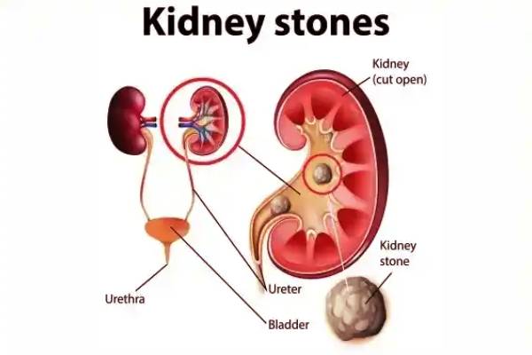 சிறுநீரகத்தில் மட்டுமல்ல இந்த 4 இடத்திலும் கற்கள் உருவாகும் - எங்கு தெரியுமா? | Stones Only In The Kidneys Also In These 4 Places சிறுநீரகத்தில் மட்டுமல்ல இந்த 4 இடத்திலும் கற்கள் உருவாகும் - எங்கு தெரியுமா? | Stones Only In The Kidneys Also In These 4 Places