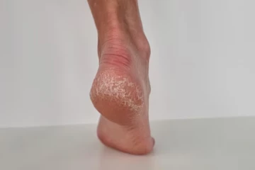 10 நாட்களில் கால் வெடிப்பை குணப்படுத்தும் வீட்டு வைத்தியம் - என்ன செய்யலாம்?