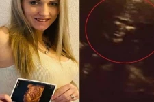 ஸ்கேனில் தெரிந்த டிரம்ப் முகம்; ஷாக் ஆன கர்ப்பிணி பெண்!