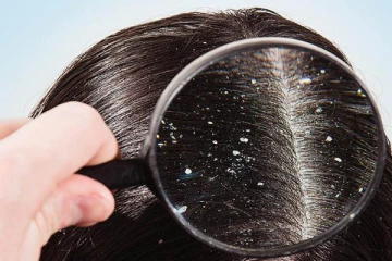 හිස්හොරි වලට බෙහෙත් සෙවිමට කලින් හිස්හොරි ඇතිවීමට බලපාන හේතු නැති කර ගන්න..