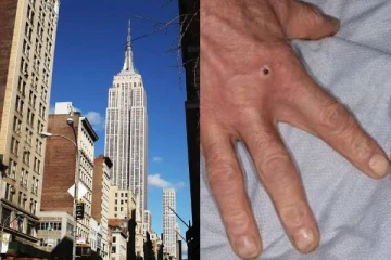 அமெரிக்காவில் குரங்கம்மை தொற்றின் மையம் இந்த நகரத்தில் தான்: சுகாதாரத்துறை எச்சரிக்கை