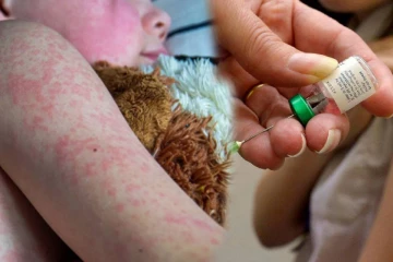 பங்களாதேஷை உலுக்கும் தட்டம்மை: 100க்கும் மேற்பட்ட சிறுவர்கள் பலி!