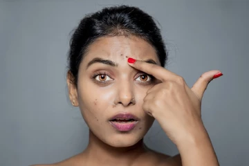 முக அழகைக் கெடுக்கும் கரும்புள்ளிகள்: வீட்டு வைத்தியம் மூலம் குணமாக்குவது எப்படி?