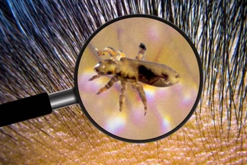 பேன் தொல்லையால் பெரும் அவதியா? இதனை ஒழிக்க இதோ சில எளிய டிப்ஸ்