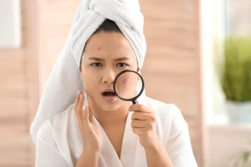 முகப்பரு பிரச்சினையா? இனி கவலைய விடுங்க