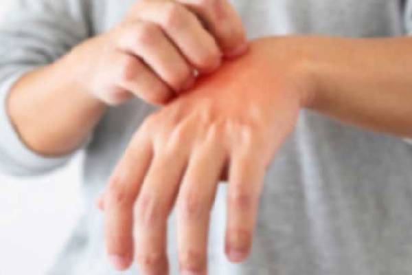 இலங்கையில் மீண்டும் தலைதூக்கும் தொழுநோய் ; சுகாதார அதிகாரிகள் எச்சரிக்கை | Leprosy Resurgence Sri Lanka Health Officials Warn