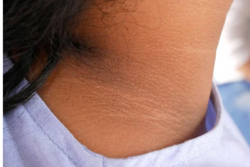 கழுத்து கருப்பா அசிங்கமா இருக்கா? கவலை வேண்டாம்... இந்த இரண்டு பொருட்கள் இருந்தால் அதிசயம் நடக்கும்!