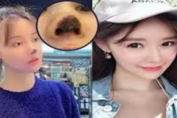 சீனா நடிகைக்கு அழகு அறுவைசிகிச்சை மூலம் ஏற்பட்ட விபரீதம்