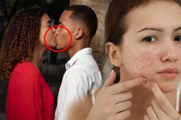 முத்தம் அதிகம் கொடுத்தா பரு வருமாம்; இனி ஜாக்கிரதையா இருங்க