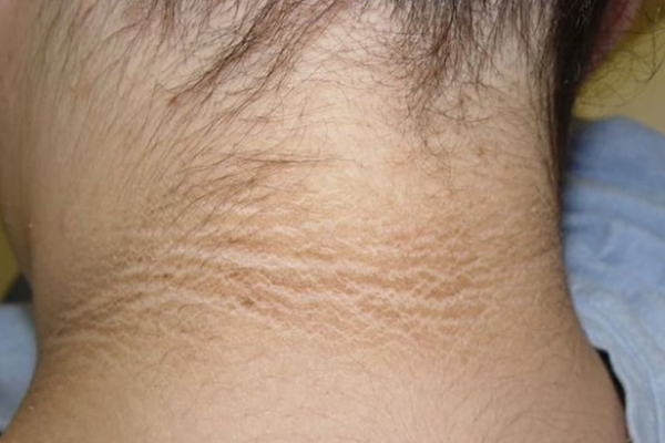 கழுத்தில் உள்ள கருமை இரண்டே வாரத்தில் நீங்க சூப்பர் டிப்ஸ் | Home Remedies To Remove Dark Neck Easily