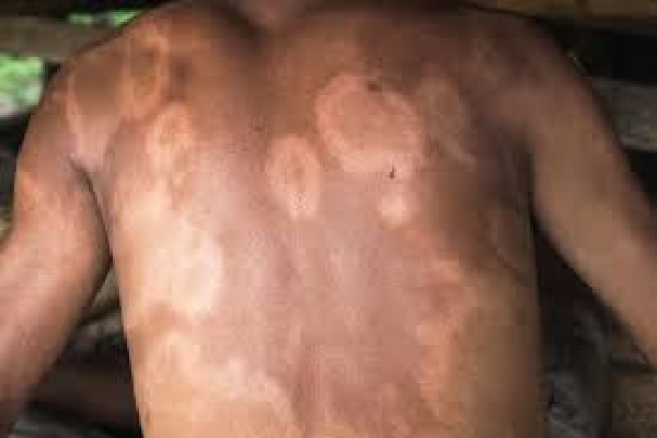 2036 ஆம் ஆண்டுக்குள் நிர்ணயிக்கப்பட்ட இலக்கு | Eliminate Leprosy From The Country By 2036