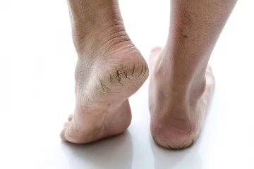 குதிகால் வெடிப்பை சரி செய்யனுமா? இதோ சில சூப்பரான டிப்ஸ்