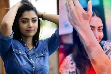 இப்படி ஒரு அரியவகை நோயா? மம்தா மோகன்தாஸ் கையை பாத்தீங்களா!