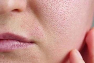 முகத்தில் இருக்கும் பெரிய சரும துளைகளை சரி செய்ய வேண்டுமா?