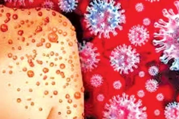 මන්කිපොක්ස්, "එම්පොක්ස්" වෙයි?..