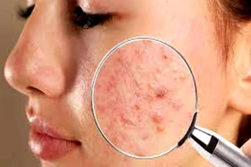 முகப்பருக்களுடன் போராடும் இளைஞர்களுக்கு ஒரு சூப்பரான பியூட்டி டிப்ஸ்!