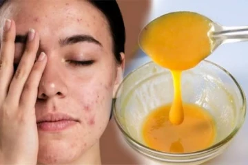 முகத்தில் உள்ள கரும்புள்ளியை நிரந்தரமாக நீக்க உதவும் எளிய வீட்டு வைத்தியம்