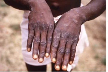 12 நாடுகளை சேர்ந்த 92 பேருக்கு குரங்கு காய்ச்சல்..!