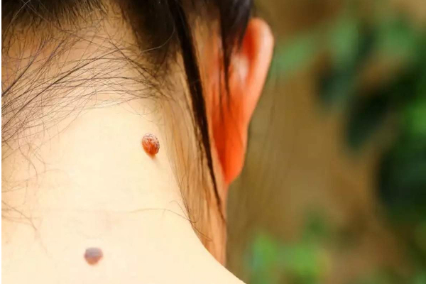 அசிங்கப்படுத்தும் மருக்களை அடியோடு அகற்ற இந்த ஒரு துளி சாறு போதும்.... இனி எட்டி கூட பார்க்காது? | Beauty Are Warts Troubling You Here Are Easy Home