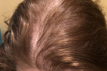 சொட்டை தெரியுதா? 5 மடங்கு முடி அடர்த்தியாக வளர இந்த எண்ணெய் தயாரித்து போடுங்க!