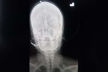 கர்ப்பிணி பெண்ணின் தலையில் அடிக்கப்பட்ட ஆணி! -ஆண் குழந்தைக்கு ஆசைப்பட்டதால் ஏற்பட்ட நிலை