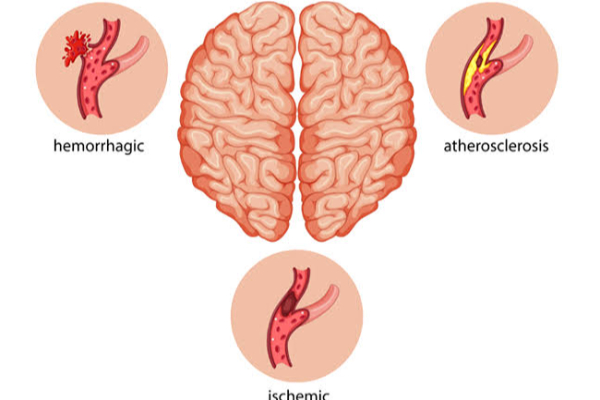 மூளைப் பக்கவாதம் ஏற்பட்டவுடன் உடனடி ஆங்கில மருத்துவம்! | Immediate English Medical Attention Upon Stroke மூளைப் பக்கவாதம் ஏற்பட்டவுடன் உடனடி ஆங்கில மருத்துவம்! | Immediate English Medical Attention Upon Stroke