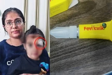 குழந்தையின் கண் அருகே காயம் - சிகிச்சைக்கு பதிலாக பசை மூலம் ஒட்டிய மருத்துவர்