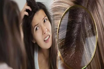 பொடுகை விரட்டியடிக்க வேண்டுமா? இதை ட்ரை பண்ணுங்க