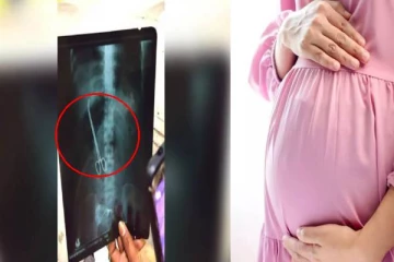 பிரசவத்திற்கு வந்த பெண்ணின் வயிற்றில் கத்தரிகோல் வைத்து தைத்த அரசு மருத்துவர்கள்