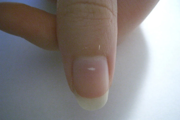 கைகளை வைத்தே உங்க ஆரோக்கியத்தை தெரிஞ்சிக்கலாம்... எப்படினு தெரியுமா? | Your Hand Says Your Health Condition கைகளை வைத்தே உங்க ஆரோக்கியத்தை தெரிஞ்சிக்கலாம்... எப்படினு தெரியுமா? | Your Hand Says Your Health Condition