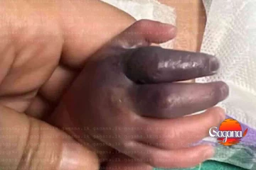 රෝහලේ වැරැද්දෙන් අලුත උපන් මල් කැකුලේ අත කපයි