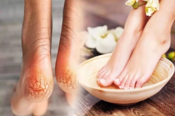 குதிகால் வெடிப்புக்கு உடனடி தீர்வு வேண்டுமா? இந்த வீட்டு வைத்தியத்தை ட்ரை பண்ணுங்க