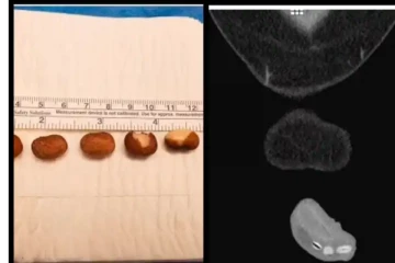 சிறுநீரக குழாய்க்குள் 6 சிவப்பு காராமணியை நுழைத்த வாலிபர்! வலி பொறுக்க முடியாததால் எடுத்த அதிரடி முடிவு