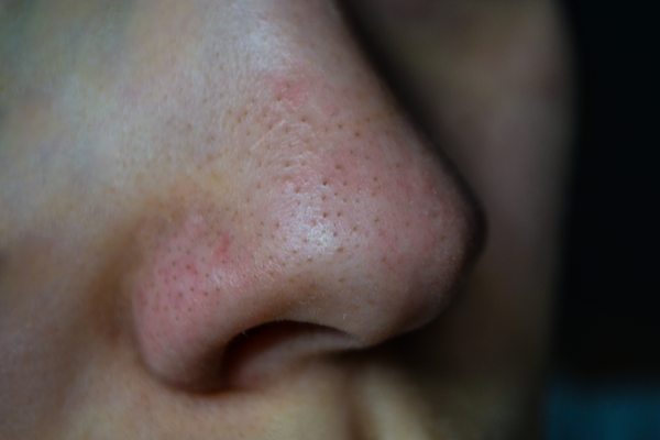 மூக்கின் மேல் இருக்கும் கரும்புள்ளிகளைப் போக்க வேண்டுமா? | Remove Blackheads From Nose