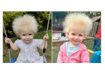 சீப்பு கொண்டு சீவினாலும் அடங்காத தலை முடி... அரிய வகை நோயால் பாதிக்கப்பட்ட சிறுமி!