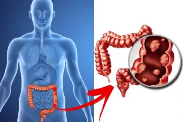 இந்த அறிகுறிகள் இருந்தால் உங்க மலக்குடலில் புற்றுநோய் செல்கள் வளருதுனு அர்த்தமாம்... உயிருக்கு ஆபத்து!