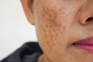 மூன்றே நாட்களில் முகத்தில் உள்ள கரும்புள்ளிகள் மறைய வேண்டுமா? இதோ சூப்பர் டிப்ஸ்