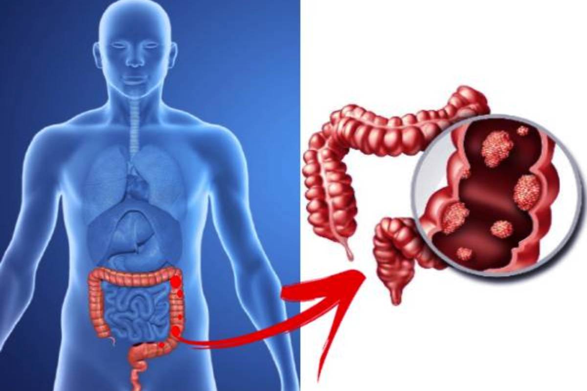 வாயில் இந்த அறிகுறிகள் இருக்கா? அப்போ பெருங்குடல் புற்றுநோய் இருக்கு | Colon Cancer Causes Symptoms On Mouth