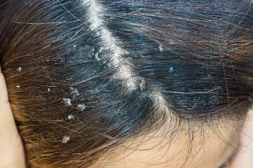 எப்படியாப்பட்ட பொடுகையும் இந்த ஒரே ஒரு பொருளை வெச்சே விரட்டியடிக்க முடியும்!