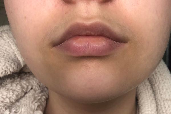 வாயை சுத்தி அசிங்கமா கருப்பா இருக்கா? பத்தே நிமிடத்தில் போக்க இந்த ஒரே ஒரு பொருள் போதும்! | Effective Ways To Get Rid Of Darkness